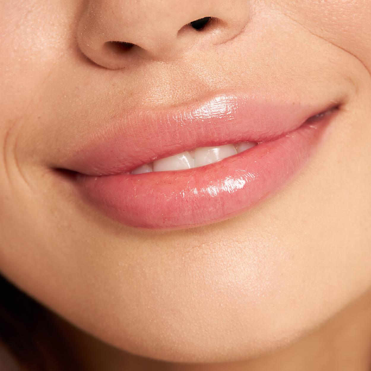 Lip filler treatment results
